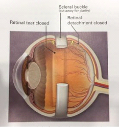 band around eye after retina surgery band around eye after retina surgery